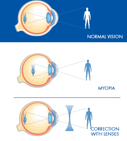 myopia